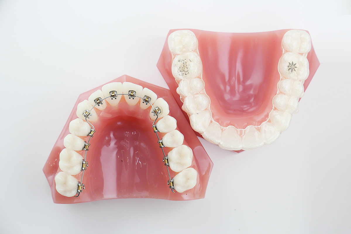 ハイブリッドでの治療 | 横浜の矯正歯科はSYNC横浜元町矯正歯科